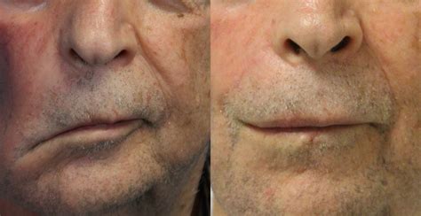 Facial Droop Which Side Stroke at Sarah Bugarin blog