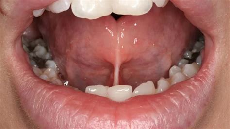 Tongue Tie in Babies: Symptoms, Causes, and Laser Treatment