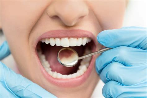 How Dentists Fill Cavities - BGW Dental Group - Blog