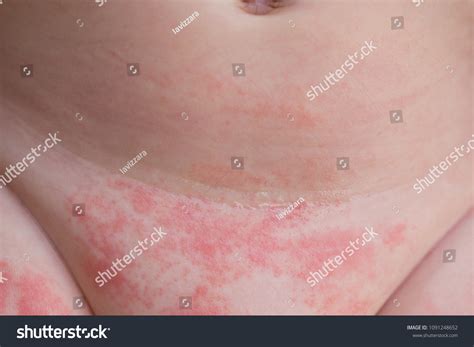 Bed Sores Vs Diaper Rash at Ian Peterson blog