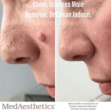 Laser Mole Removal