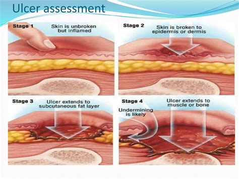 Decubitus ulcer | PPTX