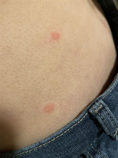 Bed Bug Stress Hives