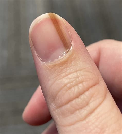 What Causes Black Spots Under Thumb Nail at Amanda Stephens blog