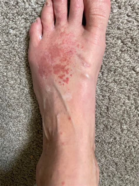 Rash or fungus on tops of feet and ankles. Some on leg above ankle. : r ...