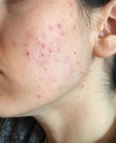 Mild Acne On Cheeks