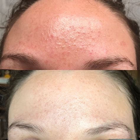 Dandruff Shampoo Used For Fungal Acne at Jayden Abdullah blog