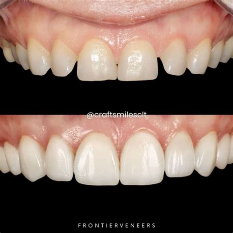 Case Studies - Frontier Dental Laboratories