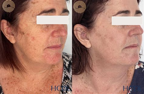 Does Co2 Laser Damage Skin at Katherine Roosa blog