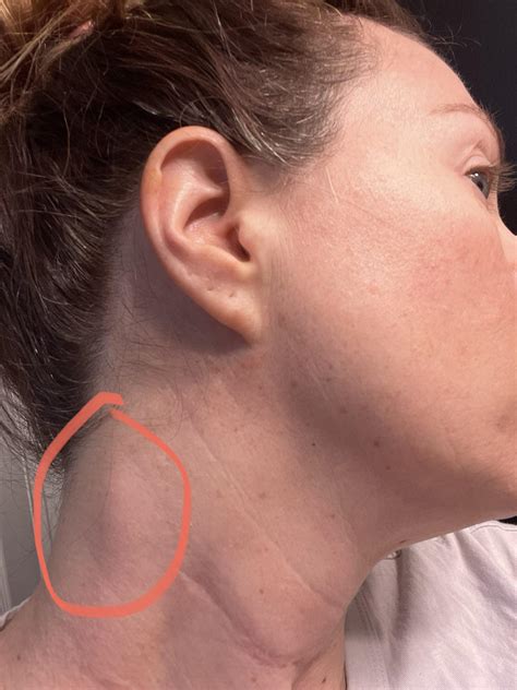 Left Side Swollen Lymph Neck