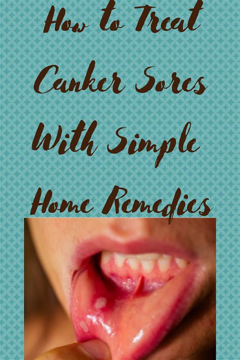 Canker Sore Treatment At Home