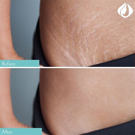 Can Stretch Marks Be Removed