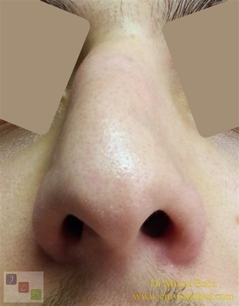 Rhinoplasty Operation For Crooked Nose