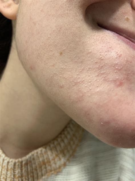 [Skin Concern] Help with these tiny white bumps on chin : r ...