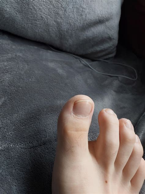 Big toe callus that does not go away! : r/DermatologyQuestions