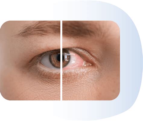 How UV Damages Your Eyes | EyeCarePro | Marketing