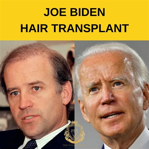 Joe Biden Hair Transplant - Hair Center of Turkey