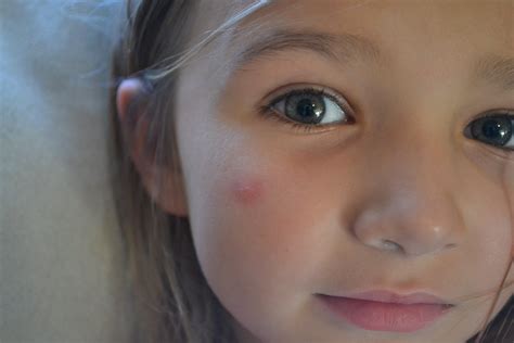 Insect Bite Swelling On Forehead at Lynn Medford blog
