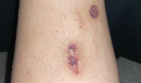 recently healed burn scars, are they supposed to be this burgundy/dark ...