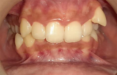 Overbite [Teeth] | Causes Correction & How To Fix An Overbite ...