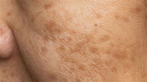 Sun Damage & Spots - Optima Medical Cosmetic Clinic