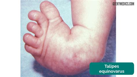 Newborn Baby Assessment (NIPE) - OSCE Guide | Geeky Medics