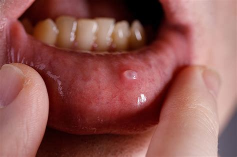 Mucocele – Symptomer, årsager og behandling | GUM®