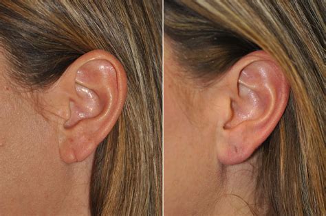 Earlobe Repair in Virginia, Washington D.C. & Maryland