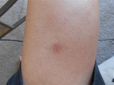 Spider Bites Only On Legs