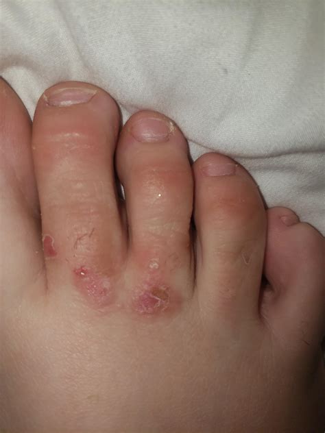 Blisters On Little Toe From Shoes at Ilene Ribeiro blog