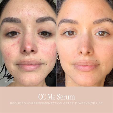 いろいろ vitamin c serum before and after photos 109717-Vitamin c serum before and after pictures