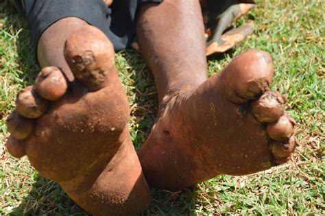 What Is Jigger Infestation at George Hodge blog