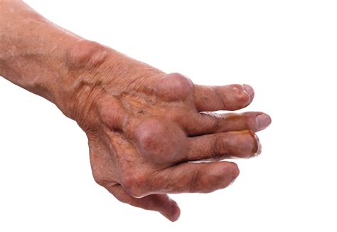 Treatment For Gout In Hands