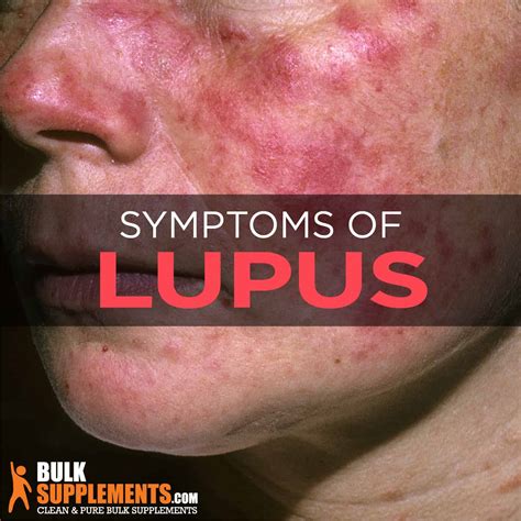 Lupus Symptoms And Treatment