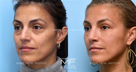 Nasolabial Fold And Bells Nasolabial Fold | Treatments The Clinic