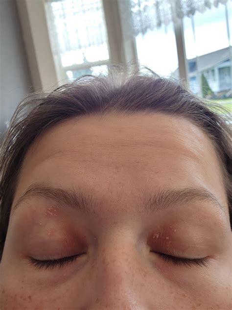 Have had psoriasis on my scalp since I was 12. Diagnosed at 24. Last couple of years it's been ...