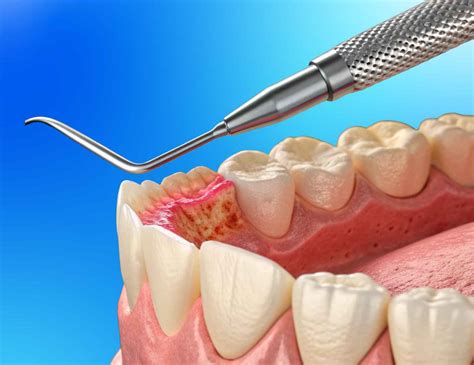 Bleeding Gums During Pregnancy