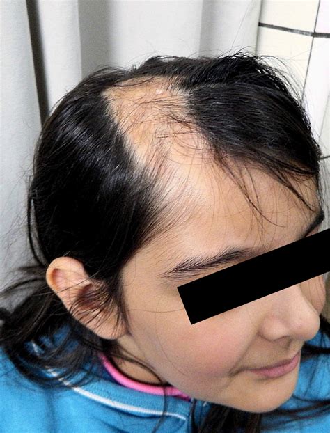 Pathology Outlines - Morphea and systemic sclerosis