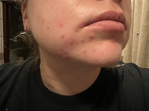Cystic acne on chin from hormonal imbalances - changed from Mirena to the pill one and a half ...