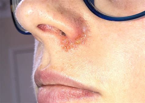 Impetigo In Nostril