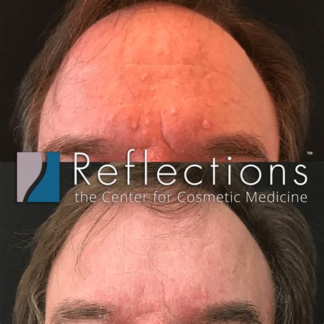 Sebaceous Hyperplasia Treatment Near Me NJ | Laser Removal Price Cost