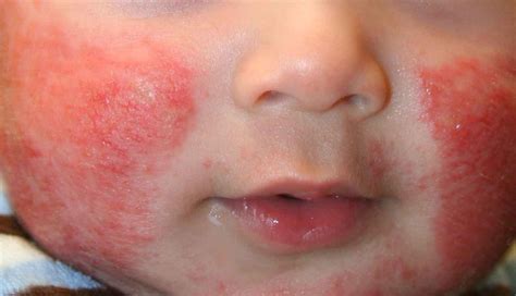 Baby Rash On Face Peeling at Carlos Palmer blog