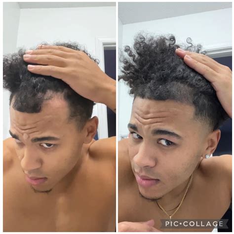 48 days of Fin, Min, and Dermaroller : r/tressless