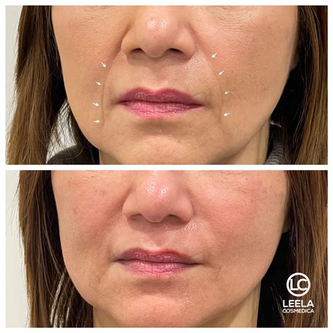 Before & After - LEELA COSMEDICA