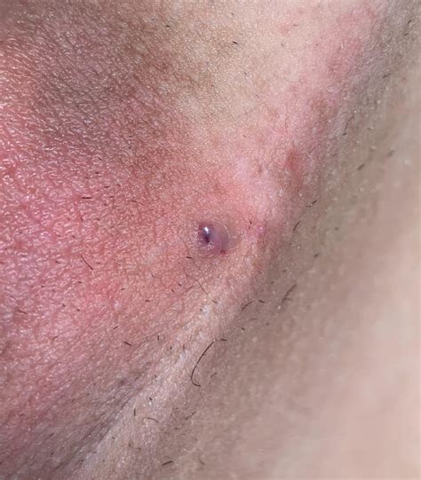 what is this bump on my labia? 23F it looks very scary. i shaved right before i noticed it ...