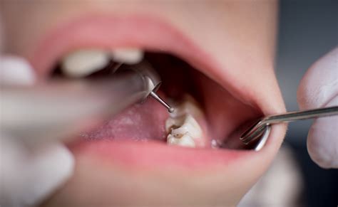 Cavity Fillings: Do They Hurt ? | Springvale Dental Clinic
