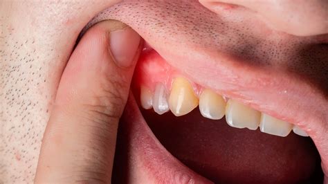 Remedies For Gum Inflammation at Scott Gold blog