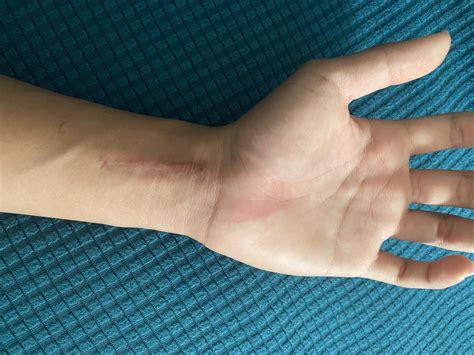 Displaced paediatric distal radius fractures with volar skin tenting ...