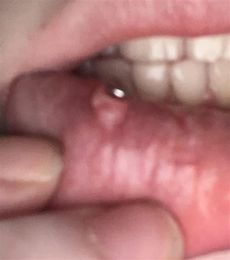 Strange bumps on snake bites : r/PiercingAdvice