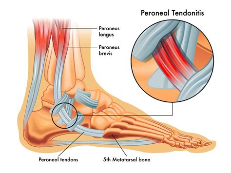 Peroneal tendonitis: throw the kitchen sink at it | Foot Problems?